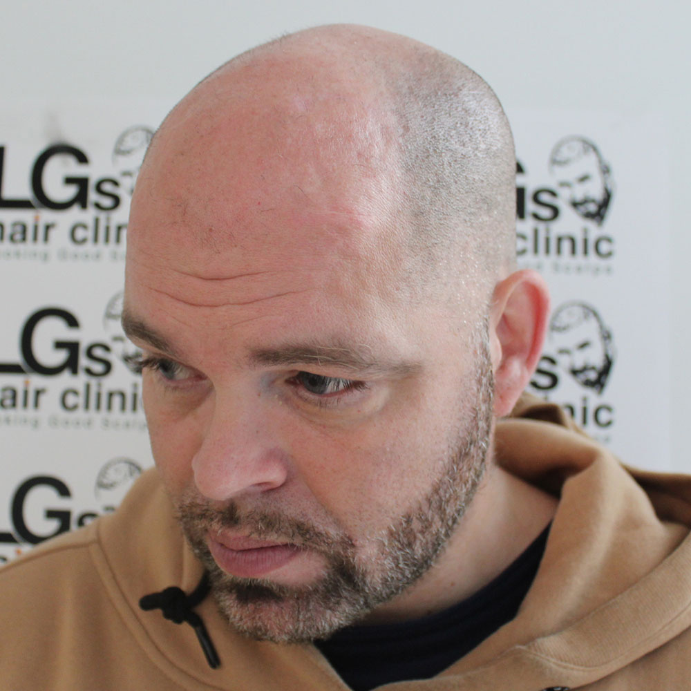 LGS Hair Clinic – Looking Good Scalps – Effective Hairloss Solution