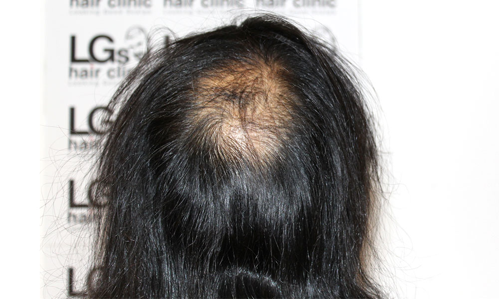 Female Hairloss treatment birmingham