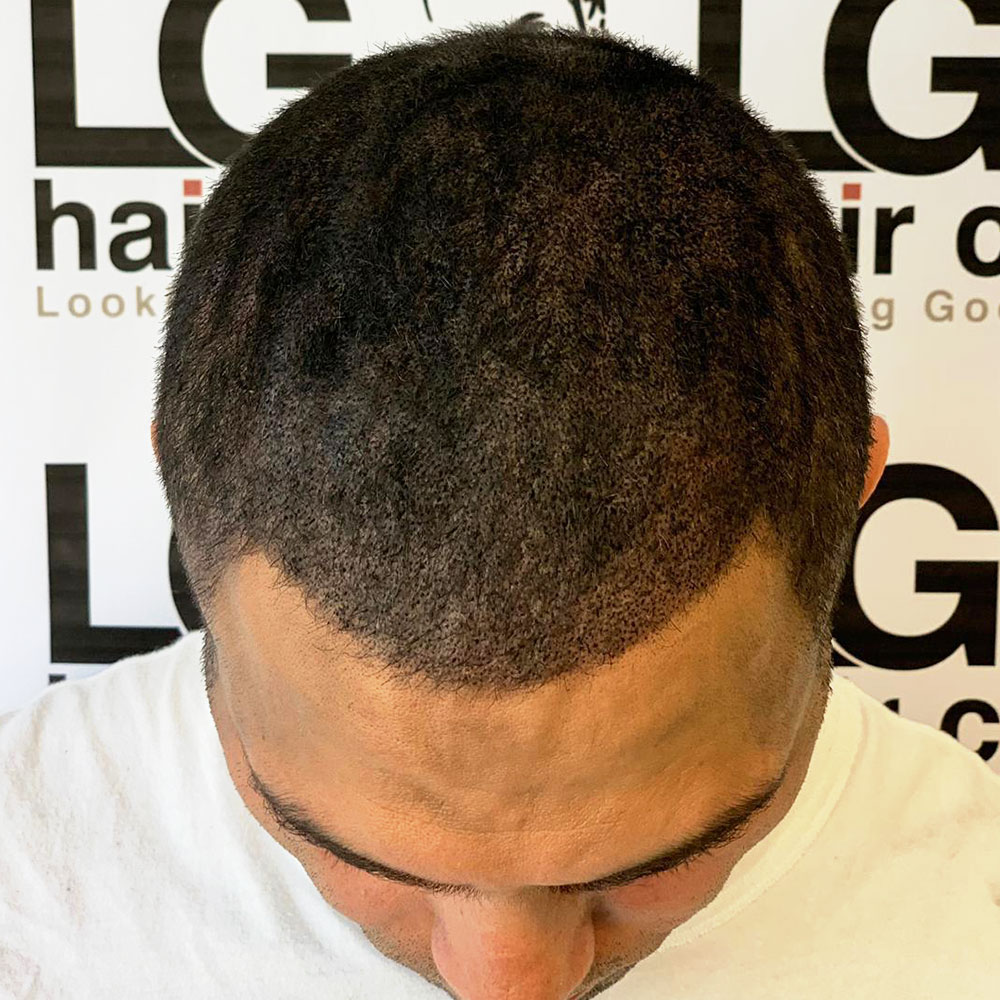 LGS Hair Clinic – Looking Good Scalps – Effective Hairloss Solution