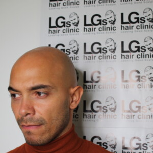 hair line tattoo treatment uk hair line tattoo treatment uk