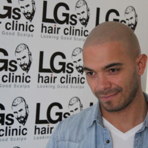 scalp micropigmentation birmingham scalp micropigmentation birmingham