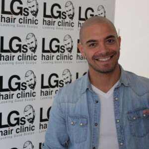 pattern baldness before after pattern baldness before after