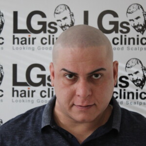 alopecia treatment uk alopecia treatment uk