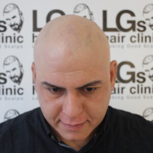 alopecia clinic london alopecia clinic london