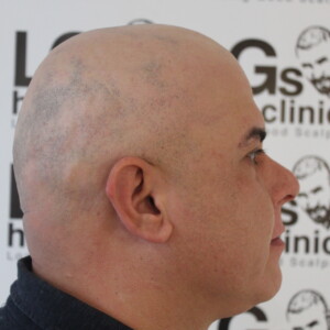 alopecia specialist uk alopecia specialist uk