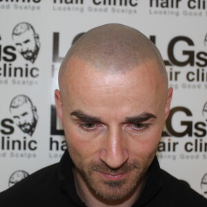 male pattern baldness treatment services male pattern baldness treatment services
