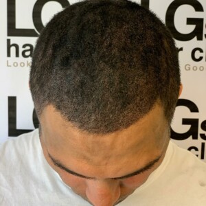 thinning hair treatment london thinning hair treatment london