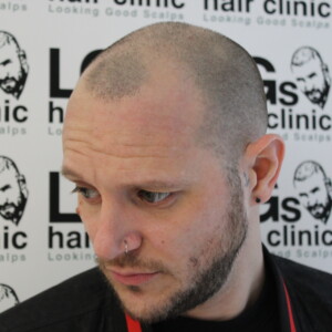 scalp micropigmentation birmingham scalp micropigmentation birmingham