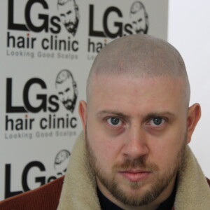 hairline tattoo birmingham cost hairline tattoo birmingham cost