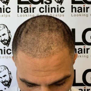 thinning hair treatment uk thinning hair treatment uk