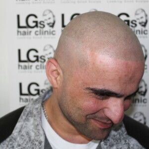 tattoo hairline before after tattoo hairline before after