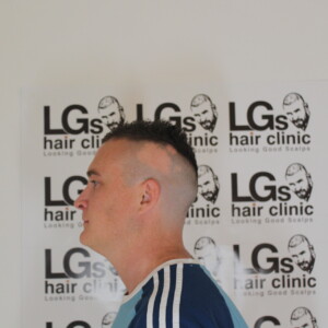 alopecia treatment uk alopecia treatment uk