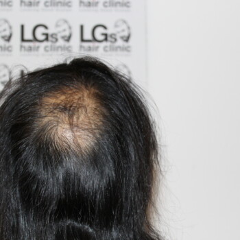 female pattern baldness treatment