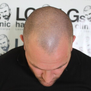 scalp micropigmentation birmingham scalp micropigmentation birmingham