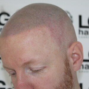 cosmetic hair tattooing cosmetic hair tattooing