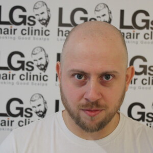 scalp micropigmentation birmingham scalp micropigmentation birmingham