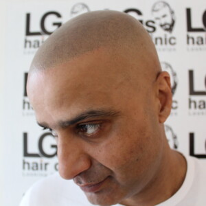 scalp micropigmentation specialists uk scalp micropigmentation specialists uk