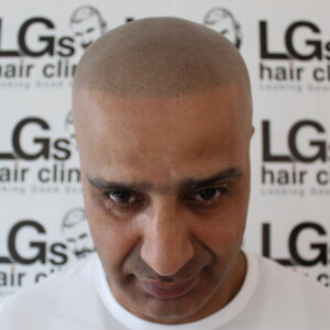 pattern baldness treatment pattern baldness treatment