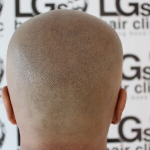 london pattern bald treatment london pattern bald treatment