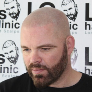 hair tattoo before and after hair tattoo before and after