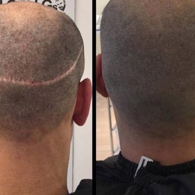 hair transplant scar treatment hair transplant scar treatment