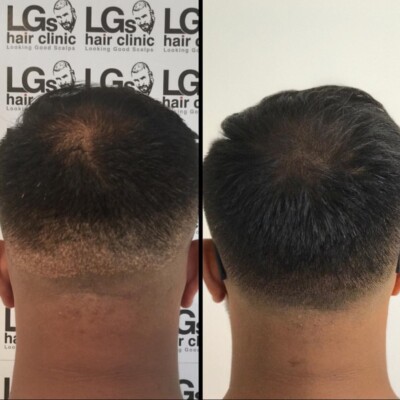 hair transplant scar treatment hair transplant scar treatment