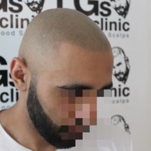 hair clinic birmingham hair clinic birmingham