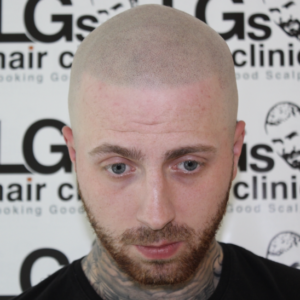 hair tattoo surgery london hair tattoo surgery london