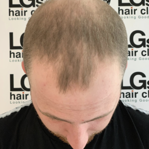 hairline tattoo near me hairline tattoo near me