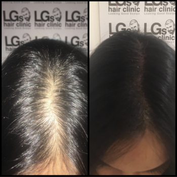 female baldness treatment uk