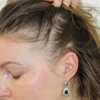 female baldness treatment services