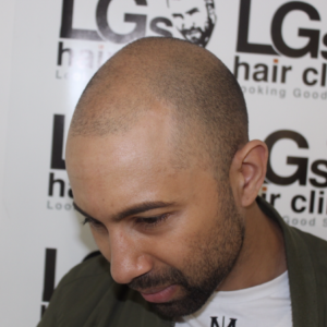 hairline surgery uk hairline surgery uk