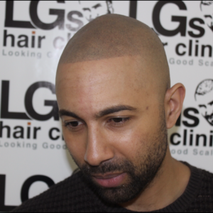 hairline surgery after hairline surgery after