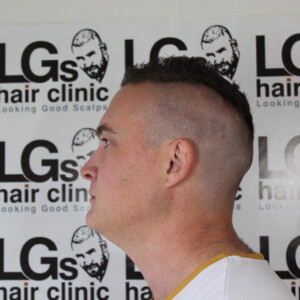 hair specialist for alopecia hair specialist for alopecia