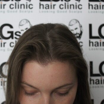 hairline tattoo female london