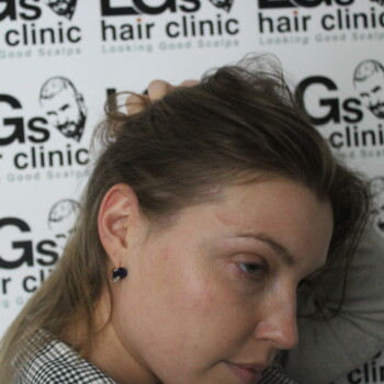hairline tattoo female