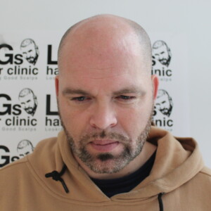 fix pattern baldness fix pattern baldness