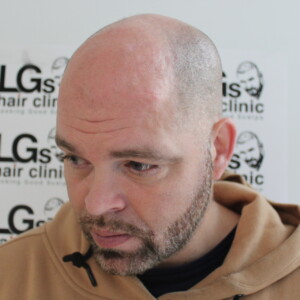 scalp hair tattoo hair loss