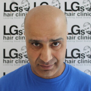 pattern baldness treatment pattern baldness treatment