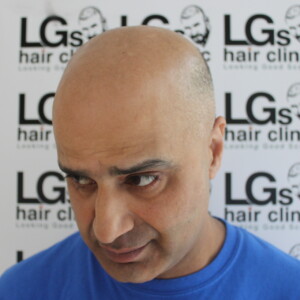 scalp micropigmentation specialists uk scalp micropigmentation specialists uk