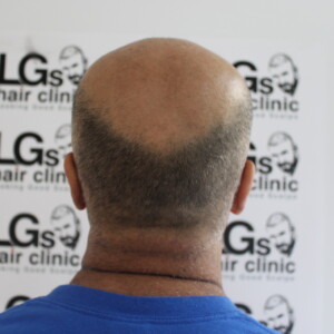 scalp micropigmentation training cost scalp micropigmentation training cost