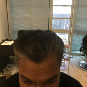 thinning hair treatment near me thinning hair treatment near me