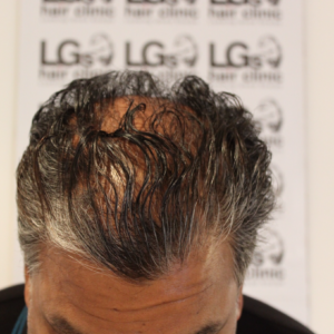thinning hair treatment birmingham thinning hair treatment birmingham