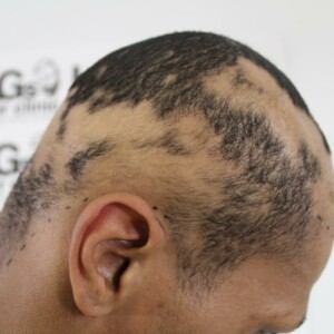 dermatologist hair loss specialist for men dermatologist hair loss specialist for men