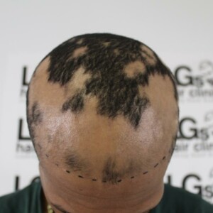 alopecia clinic alopecia clinic