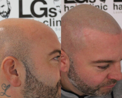 Hair tattooing Hair tattooing