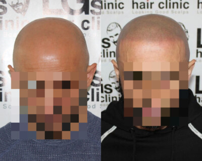 Scalp micropigmentation London Scalp micropigmentation London