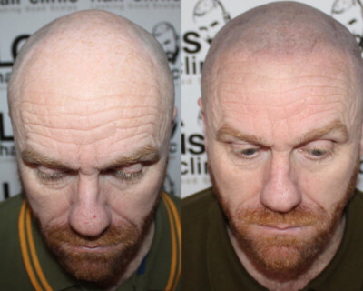 Scalp micropigmentation Scalp micropigmentation