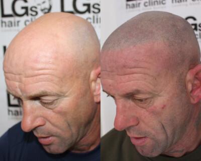 Hair tattooing Hair tattooing