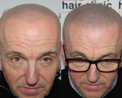 Scalp micropigmentation Birmingham Scalp micropigmentation Birmingham